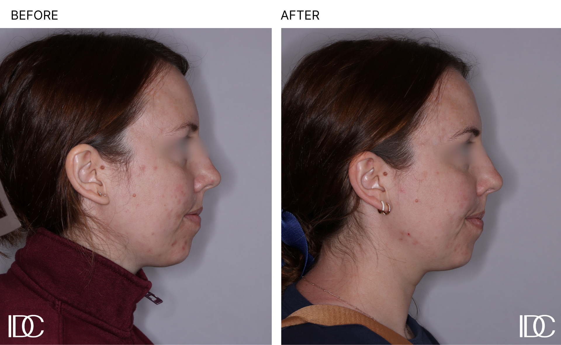 Acne & BBL pages - 3.png