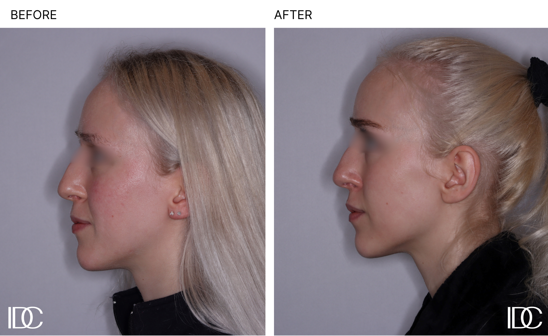 Acne & BBL pages - 3.png