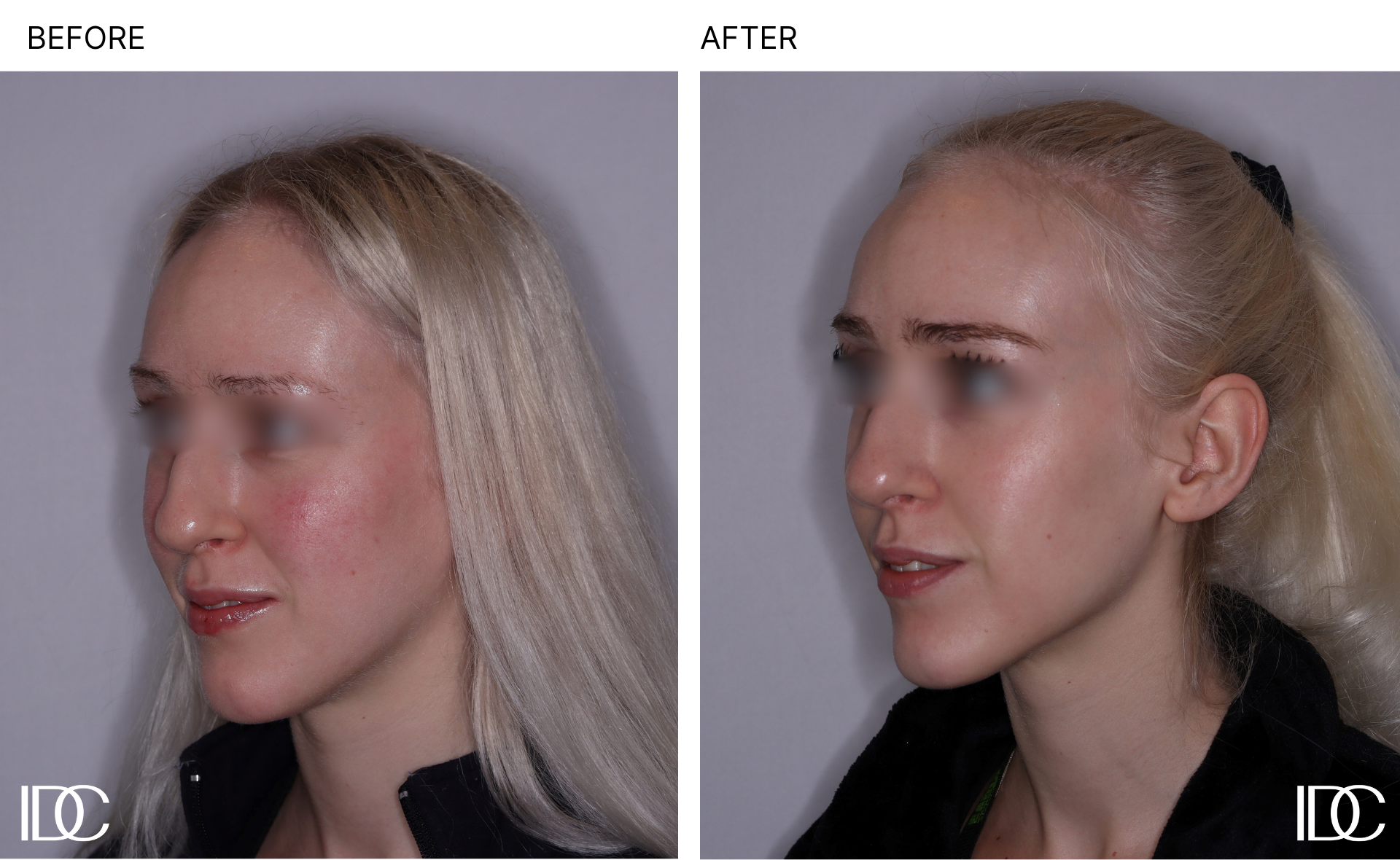 Acne & BBL pages - 4.png