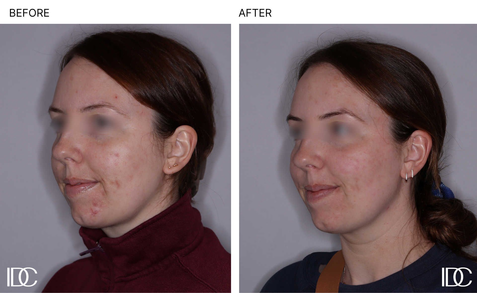 Acne & BBL pages - 5.png