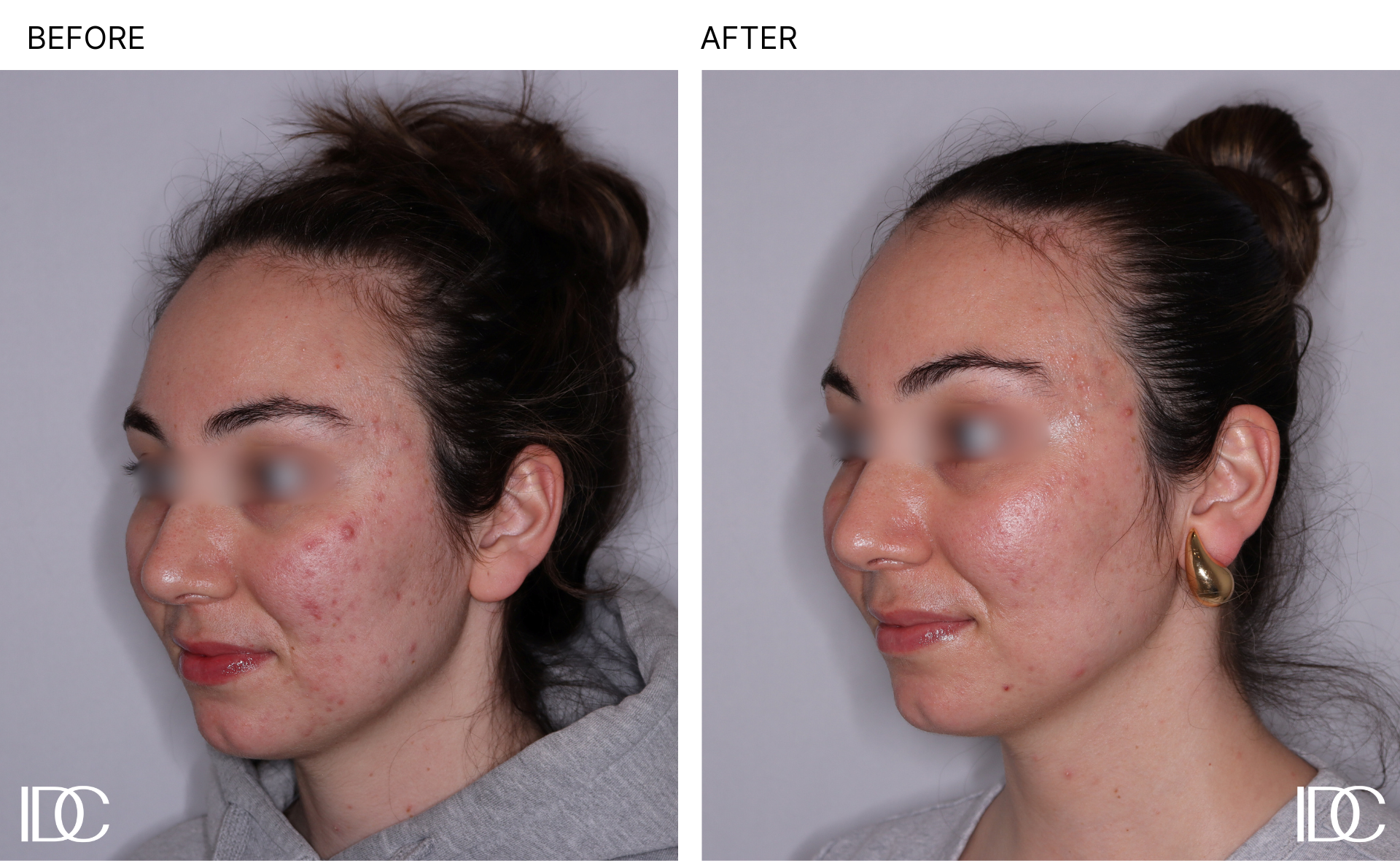 Before & After Adult Acne Treatments in Kelowna