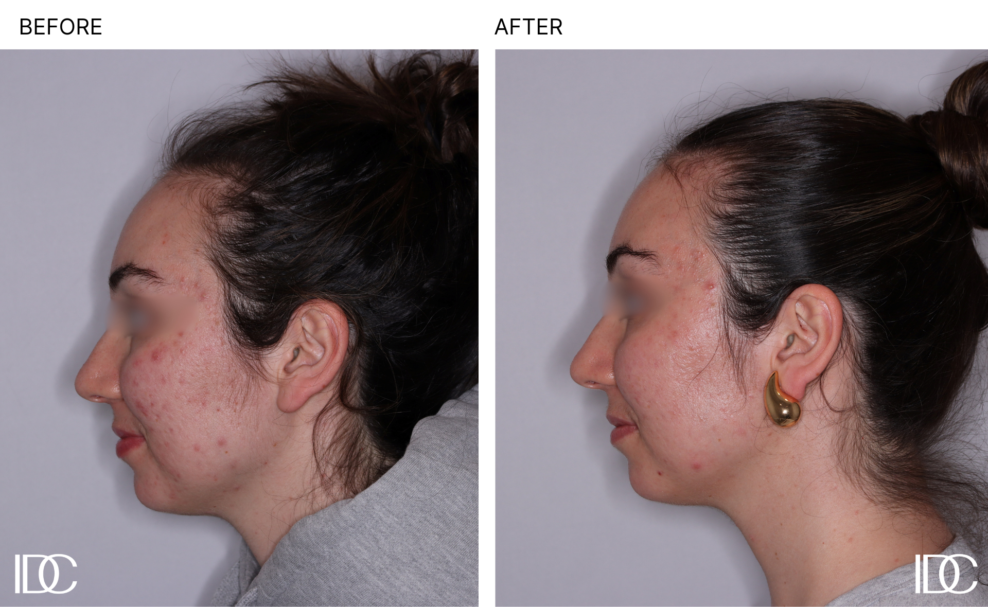 Before & After Adult Acne Treatments in Kelowna