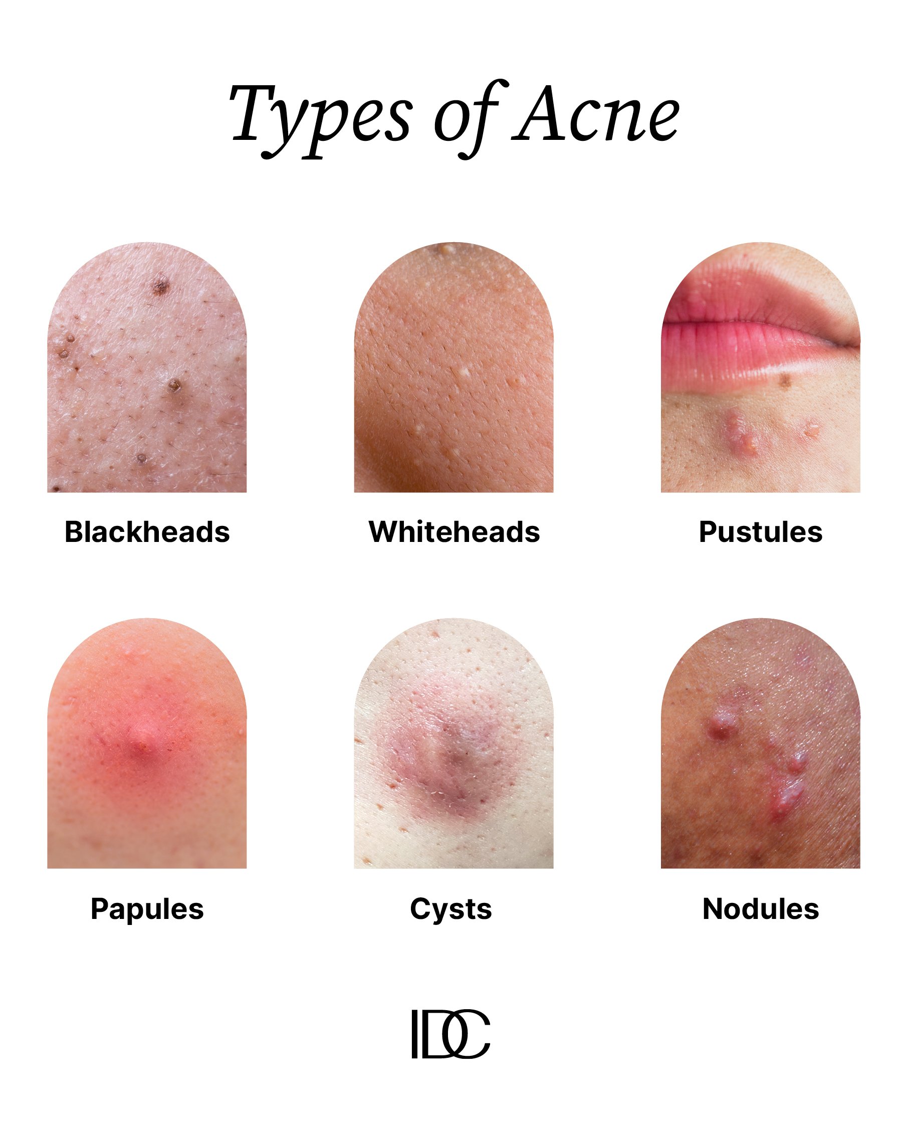 Acne Unpacked: The Tells and The Treatments for Acne-prone Skin ...
