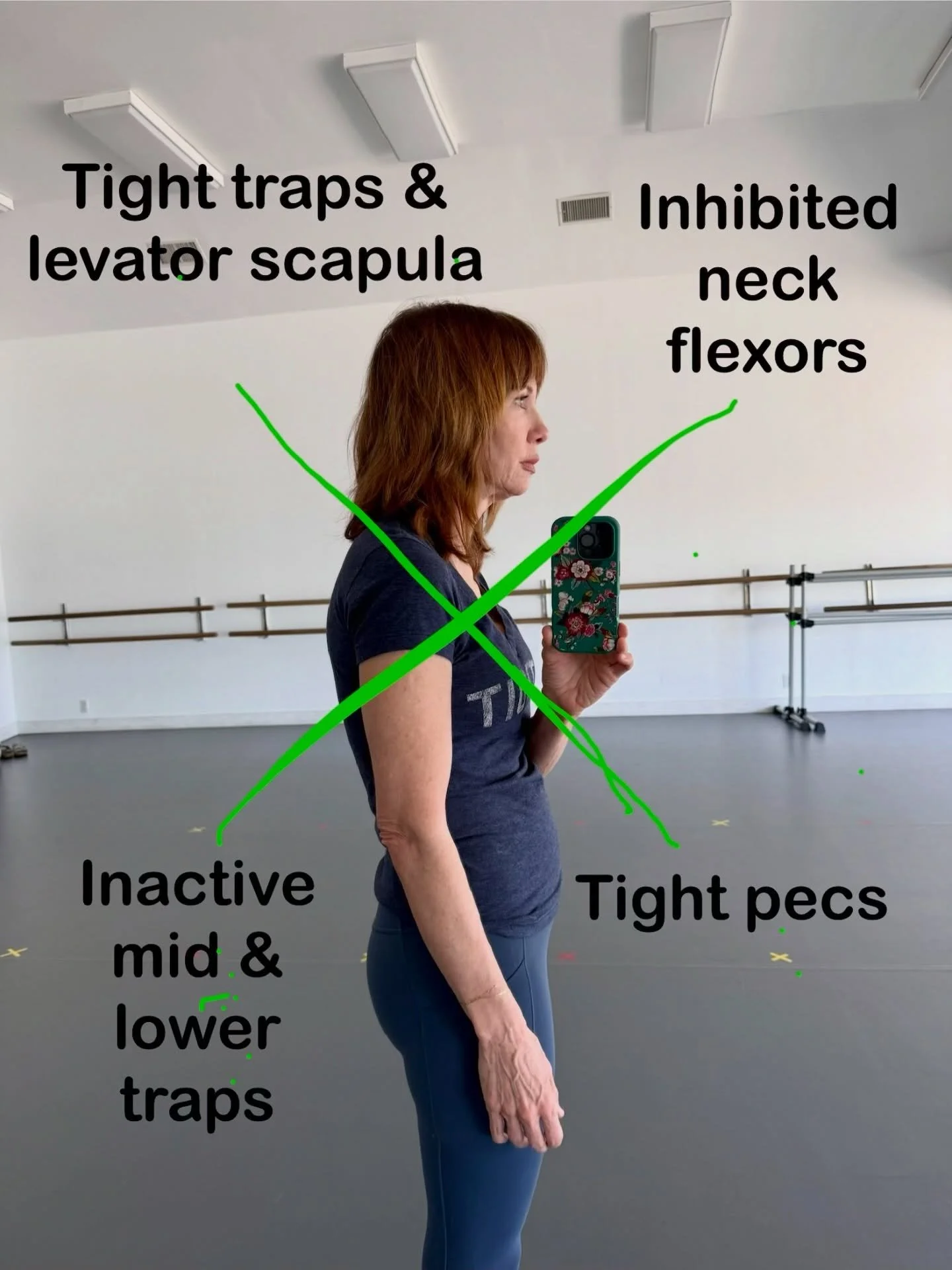 (Did your head move forward reading this?)⁣
⁣
This is Upper Cross Syndrome:⁣
⁣
👉 Head forward⁣
👉 Shoulders rounding⁣
👉 Upper back rounding⁣
👉 Scapular winging⁣
⁣
This posture is common, and I&rsquo;m noticing it more and more over the last couple