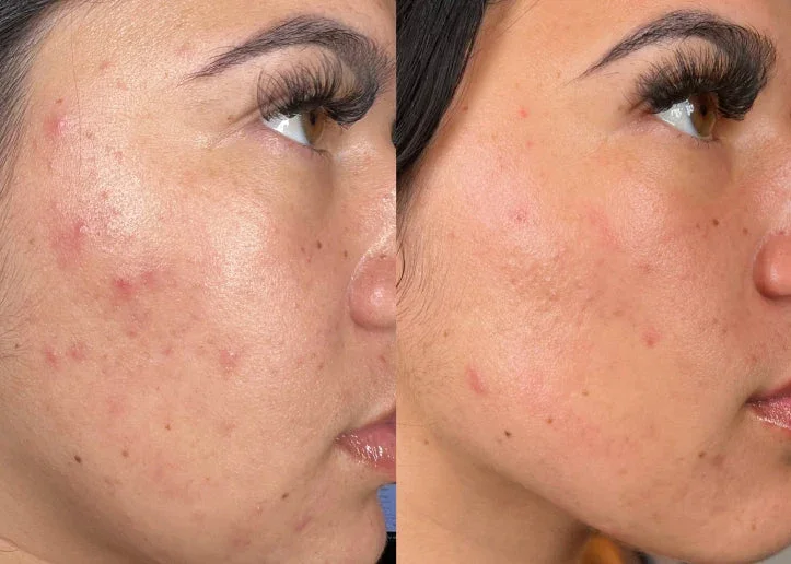 Before_After_Mobile_Acne.jpg.webp