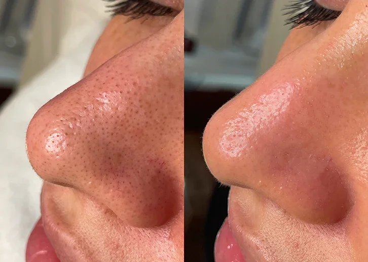 Before_After_Mobile_CloggedPores.jpg.webp