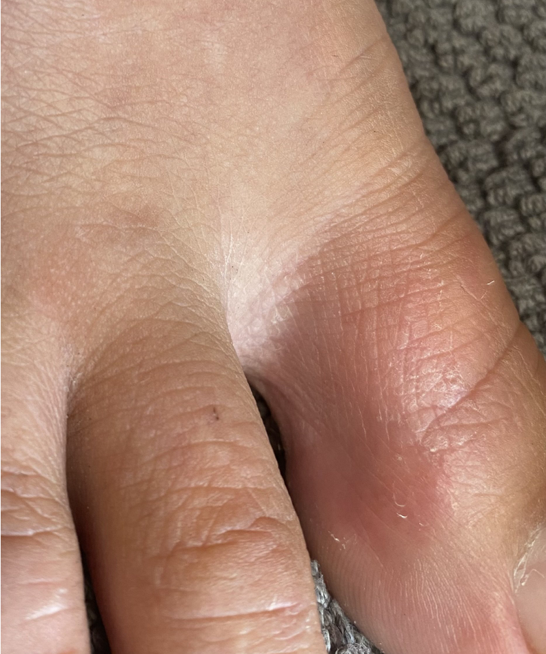 Neurodermitis — Kanzler Klinik