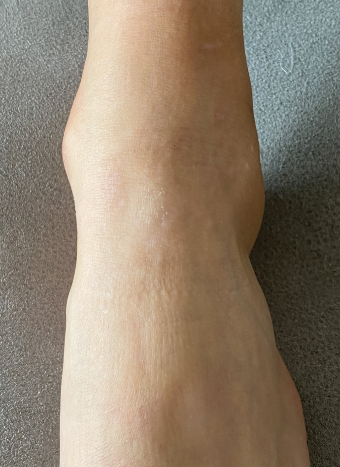 Neurodermitis — Kanzler Klinik
