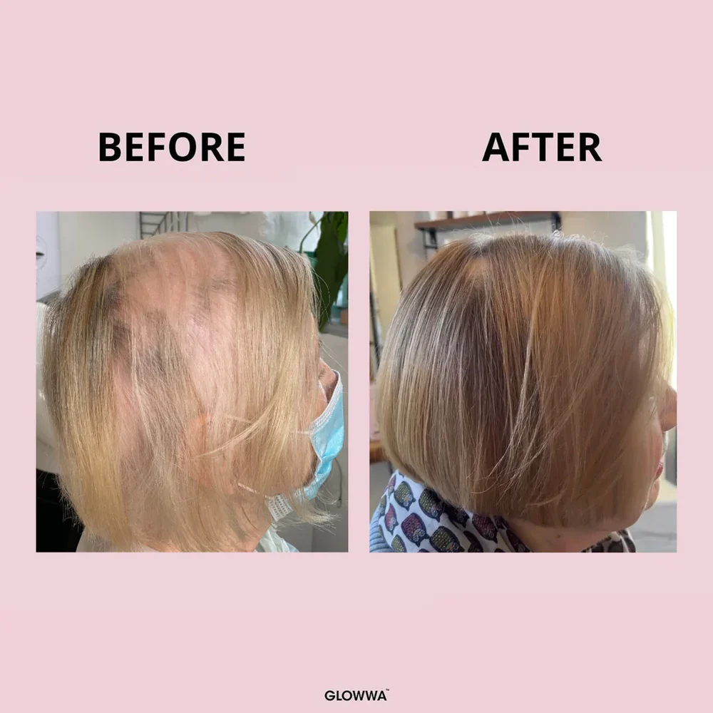 6MONTHHAIRGROWTHBUNDLE_1_1000x.webp