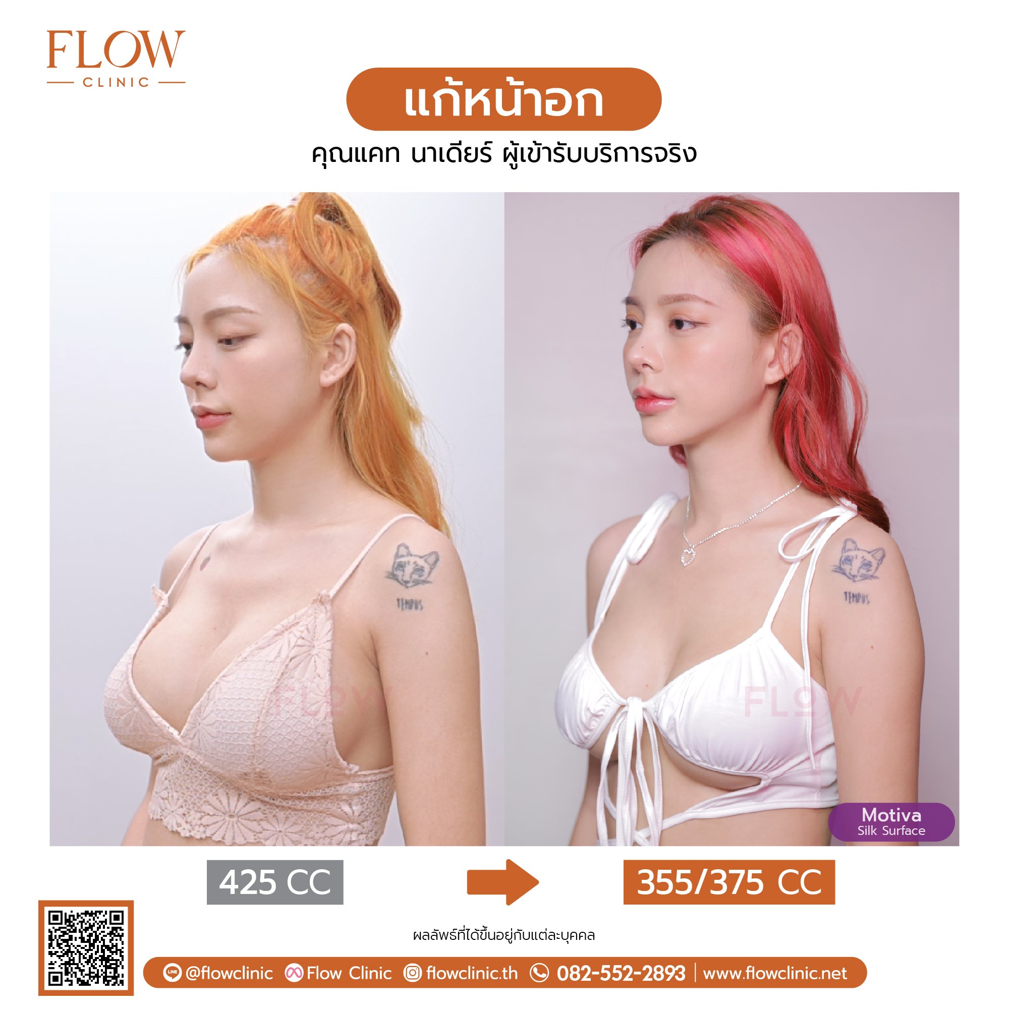 review-Flow-เสริมหน้าอก-57-02.jpg