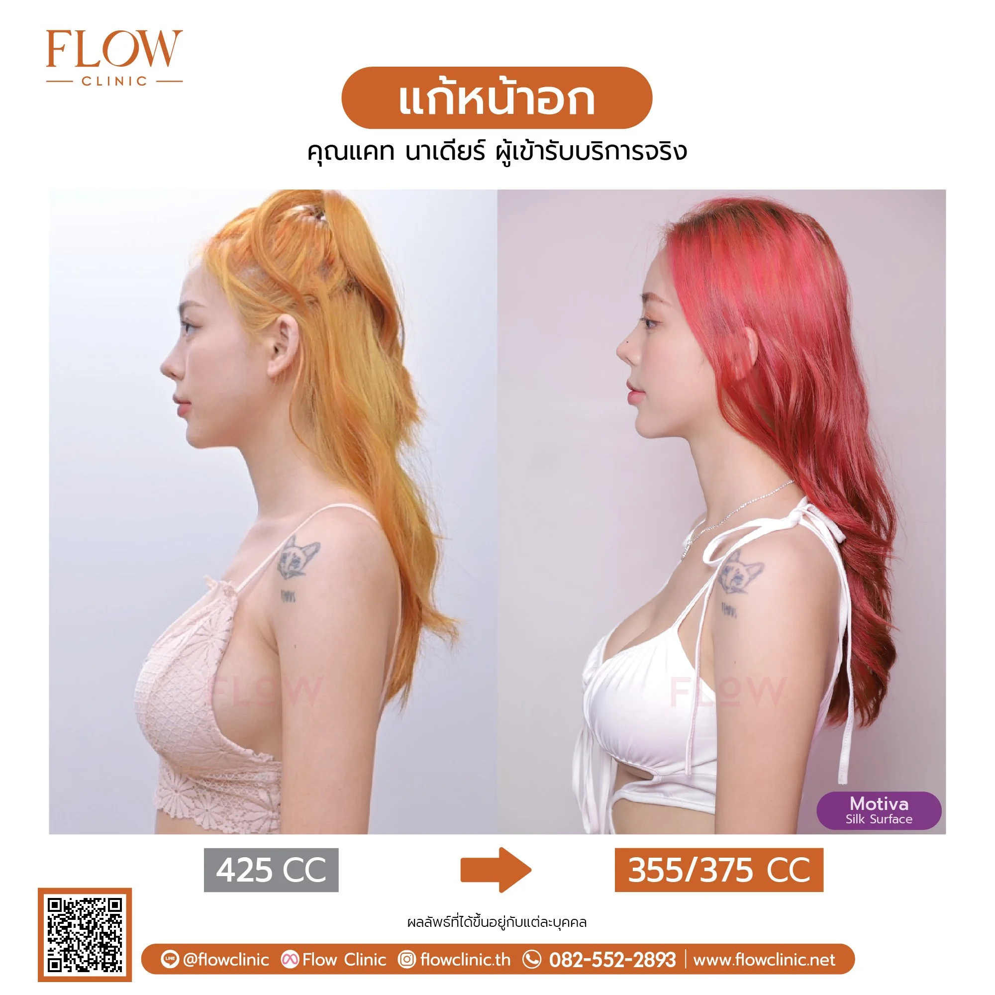 review-Flow-เสริมหน้าอก-57-03.jpg