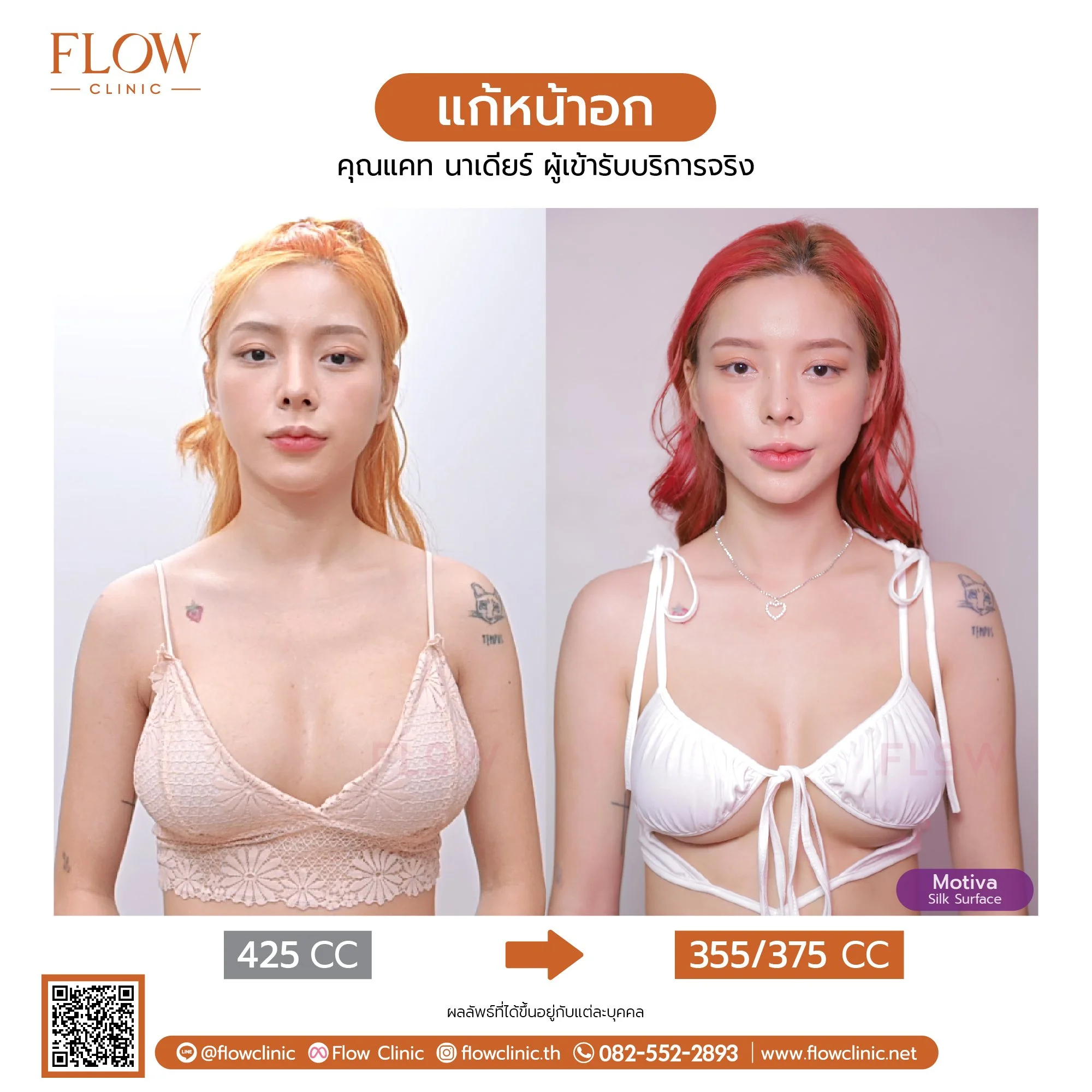 review-Flow-เสริมหน้าอก-57-01.jpg