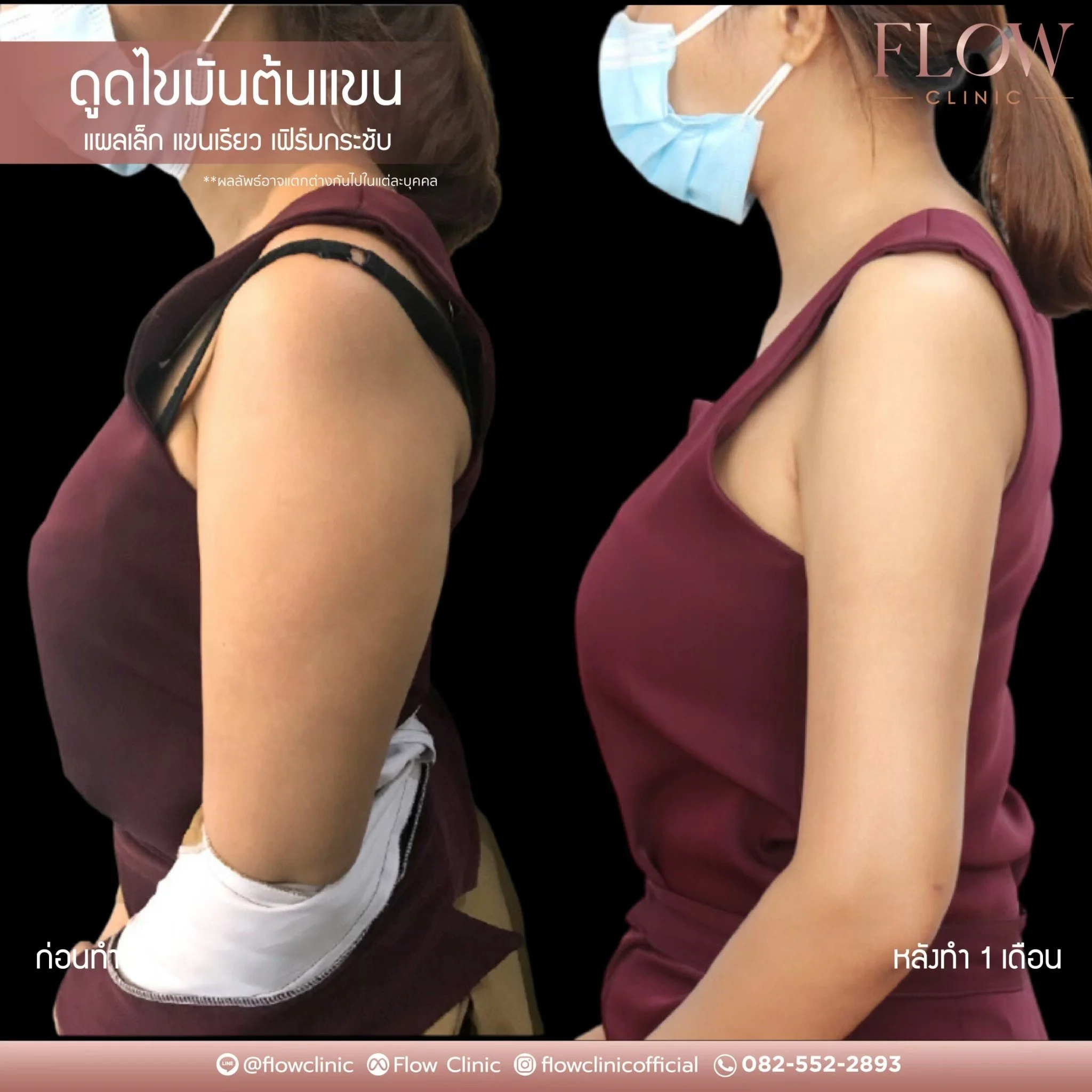LINE_ALBUM_ดูดไขมันต้นแขน_250827_8.jpg