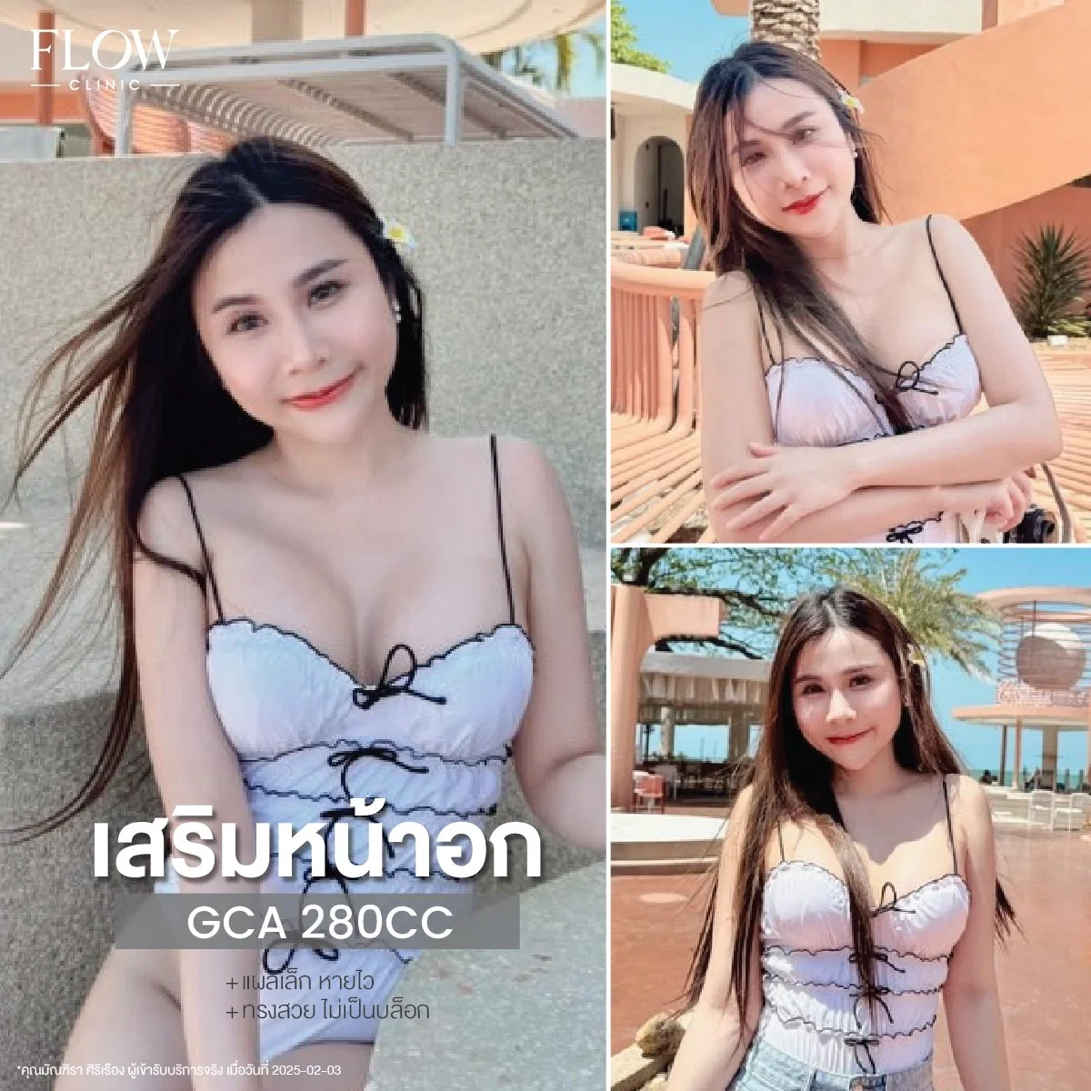 LINE_ALBUM_รีวิวเสริมหน้าอก_250827_9.jpg
