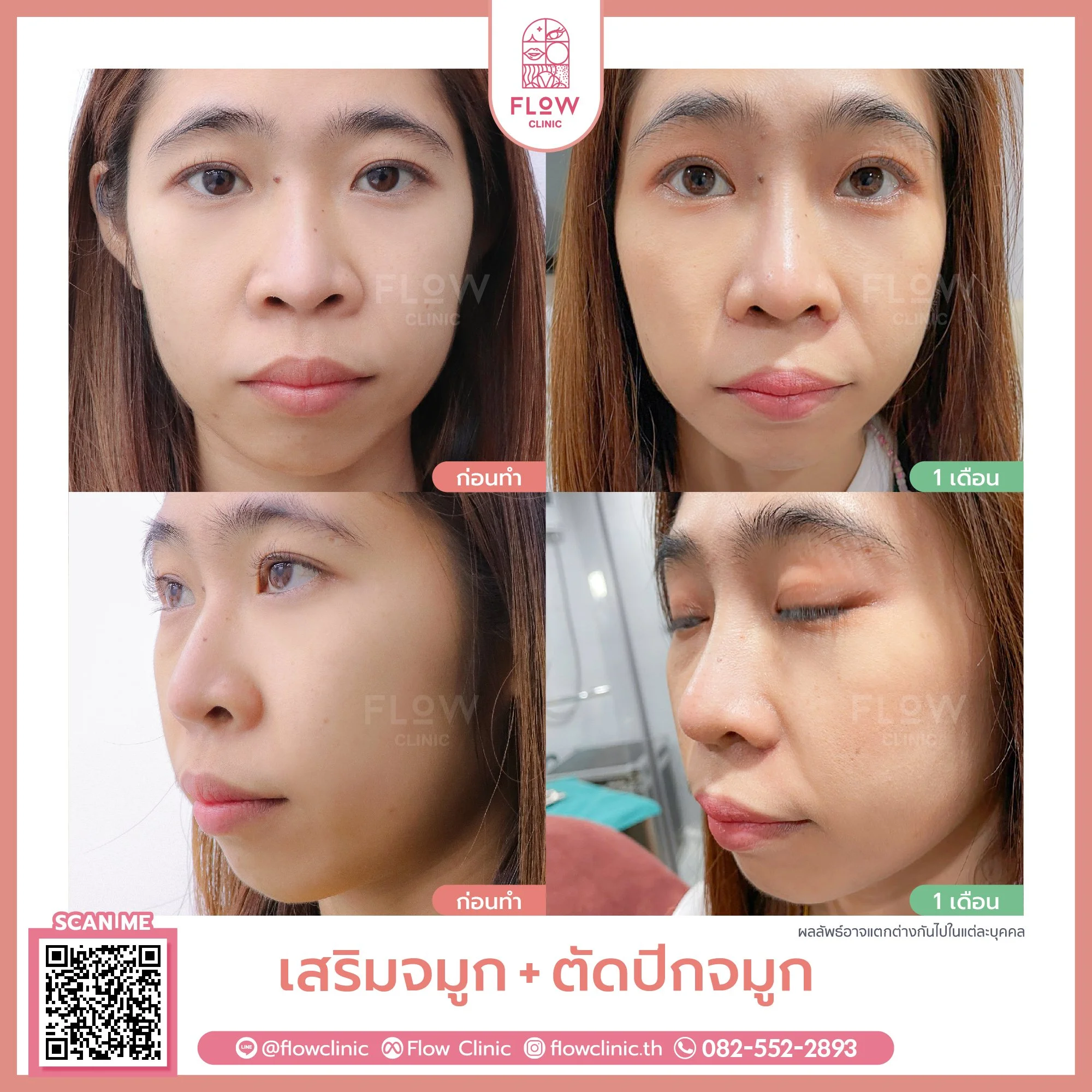Review-Flow-ตัดปีกจมูก-03-02.jpg