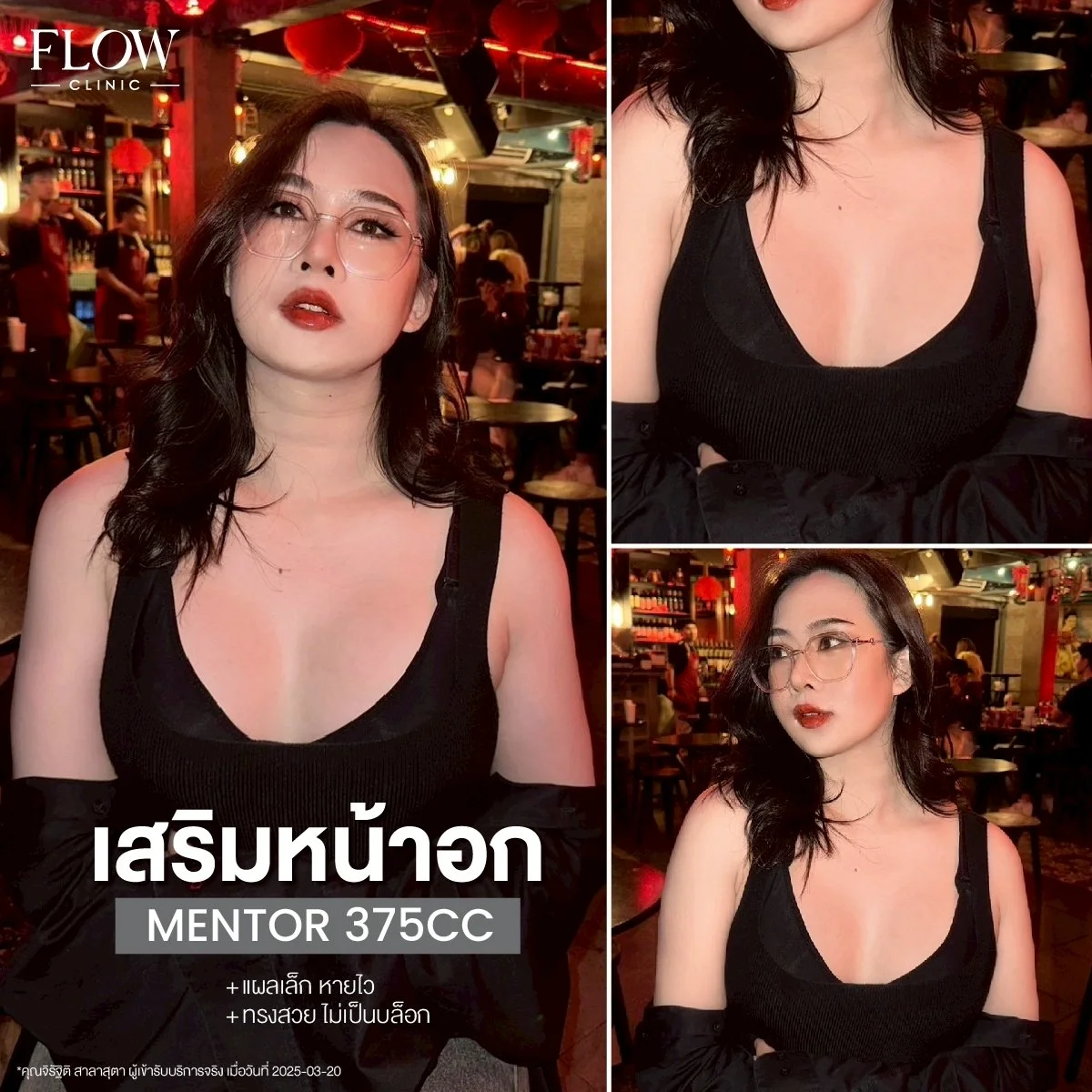LINE_ALBUM_รีวิวเสริมหน้าอก_250827_6.jpg