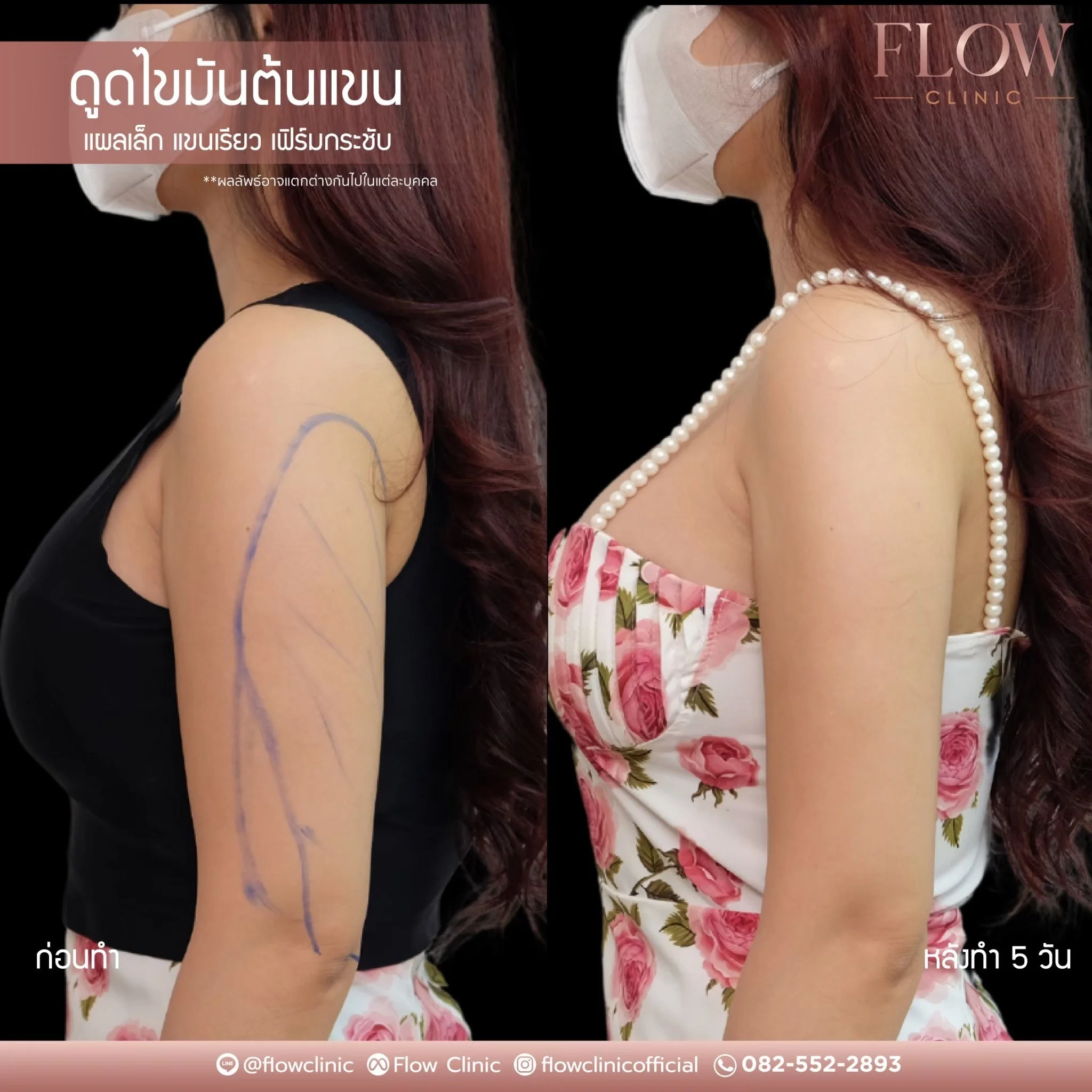 LINE_ALBUM_ดูดไขมันต้นแขน_250827_13.jpg
