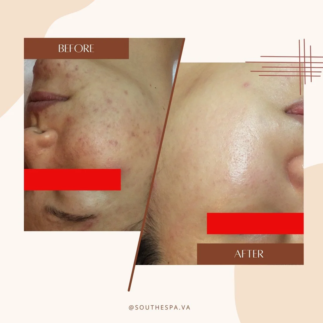 Give Thanks &amp; Clear Skin! 🎁 Gift a Skincare &amp; Headspa Experience to Help Cure Acne This Thanksgiving!
.
.
.
⏰ Every day, from 9:30 AM to 8:00 PM (except Saturday: 9:00 AM to 7:00 PM, Close Sunday)
📍 2851 Gallows Rd, Falls Church, VA 22042
☎