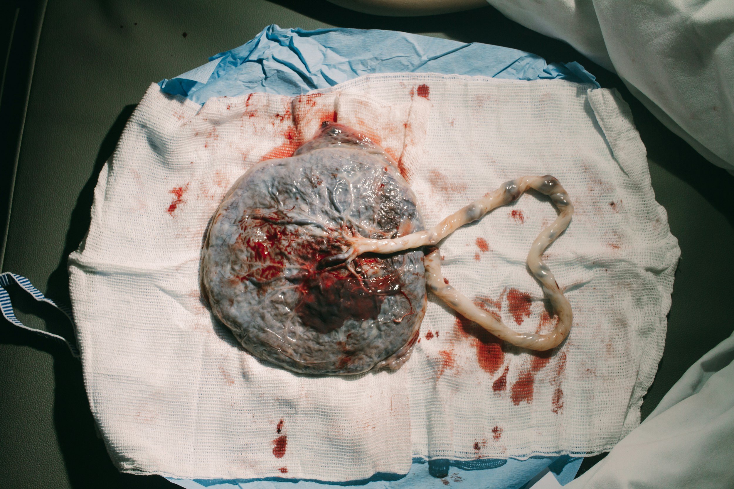 Delayed Cord Clamping