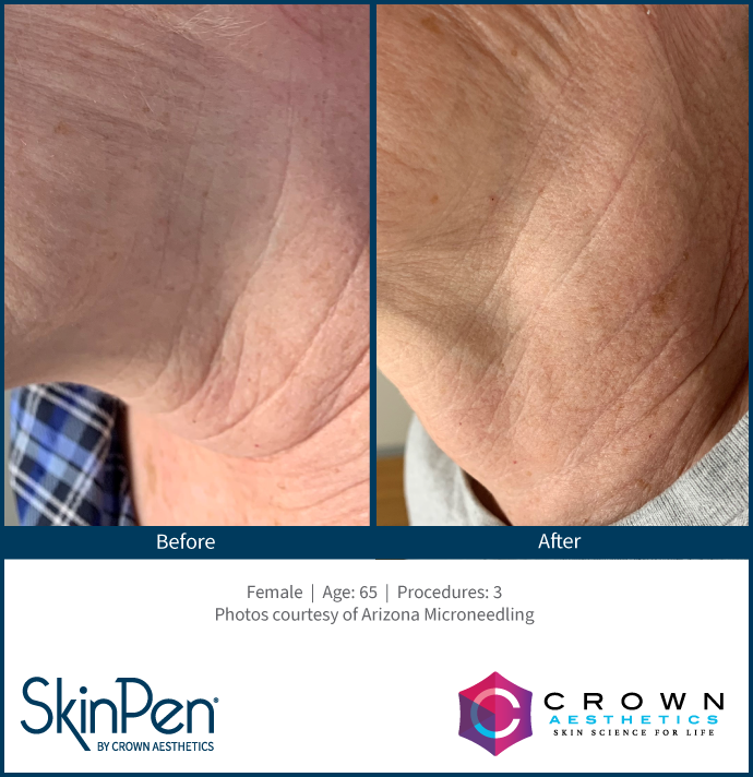 BA-SkinPen-FLAW-KH-Neck-ArizonaMicroneedling-3treatments-65YO_maxWidth_1200_maxHeight_1200_ppi_72.png