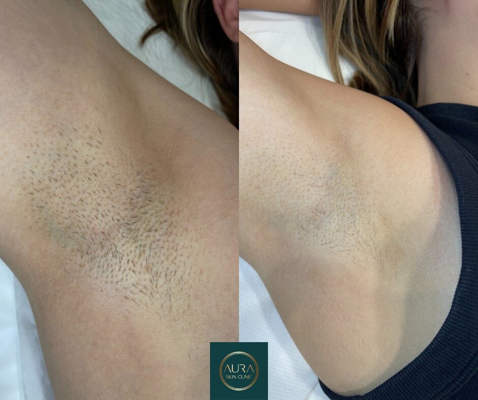 Progress 📸 after 4 sessions of laser hair removal! Few more sessions and my client will be summer ready! ☀️🏖️

Till 29th February you have an opportunity to grab yourself a course of 6 (any area) with 30% OFF! 

Use code: LASER30 at the checkout an