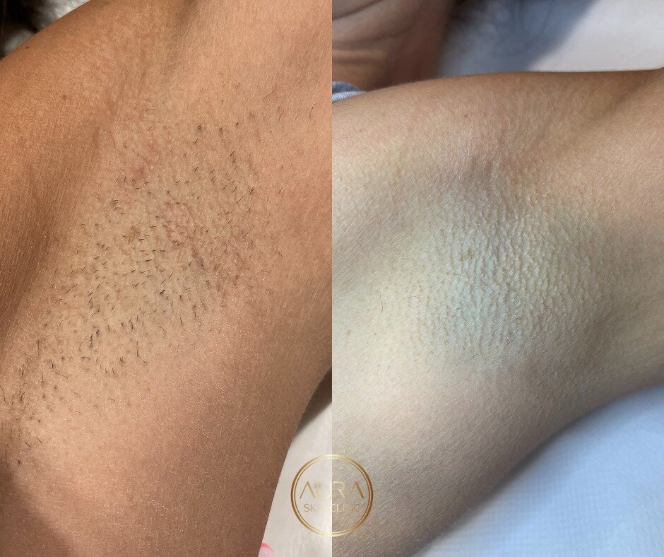 Before and after of 5 sessions of laser hair removal! 🥳 Client hasn't shaved in 6 weeks! 

There is still time to start your laser hair removal before summer arrives ☀️

30% OFF ALL Laser Hair Removal courses until 29th February! 

Book your patch t