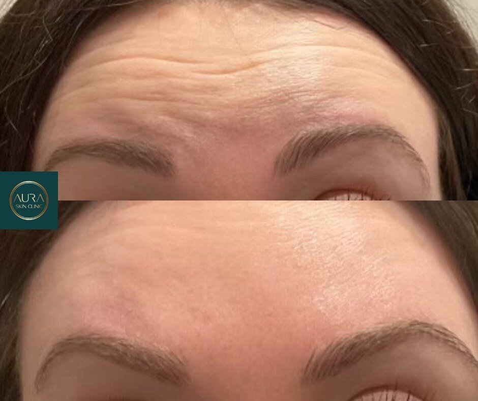 Have you ever had anti-wrinkle injections? If yes, do you have it done on a regular basis? If no, is there something scares you? 
Let me know in the comments ⬇️

Dr Faizan has a few available slots this month for aesthetics consultations, get in touc