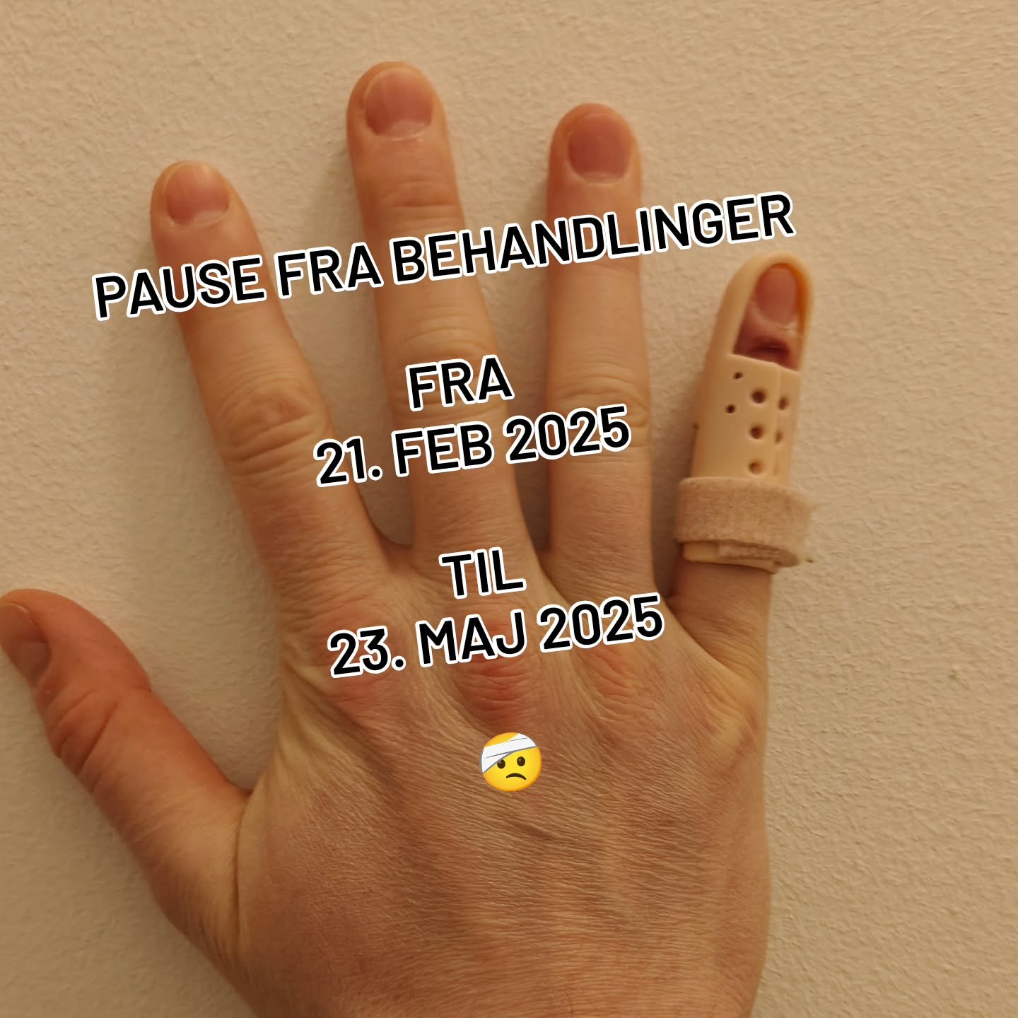 Min lillefinger kom til skade d. 21. Februar 2025.
Så for at undgå drop-finger, kan jeg ikke behandle før jeg har fået skinnen af, som jeg skal bruge frem til og med midt april.
Men det falder på et dårligt ti