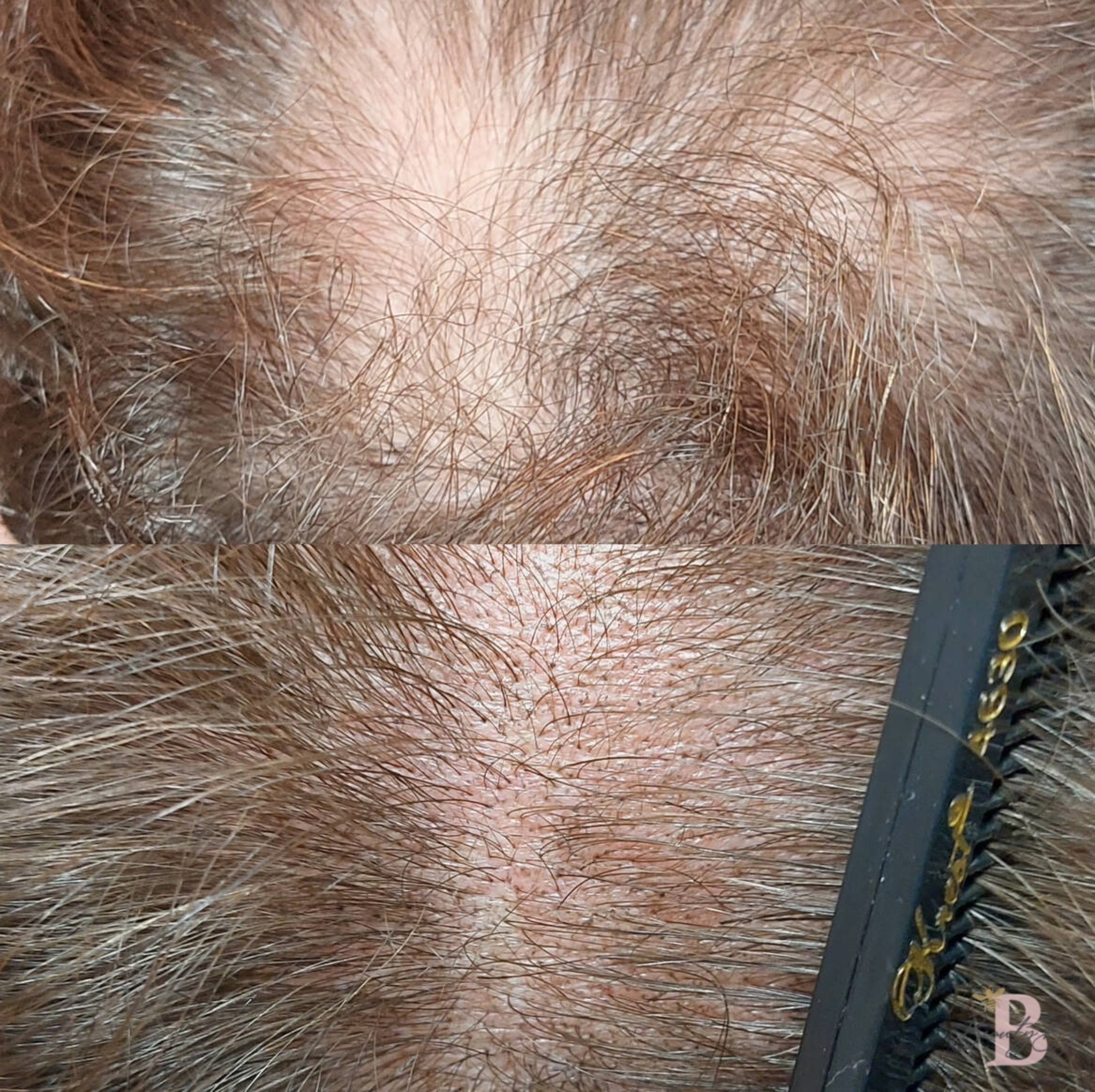 Scalp micropigmentation before and after