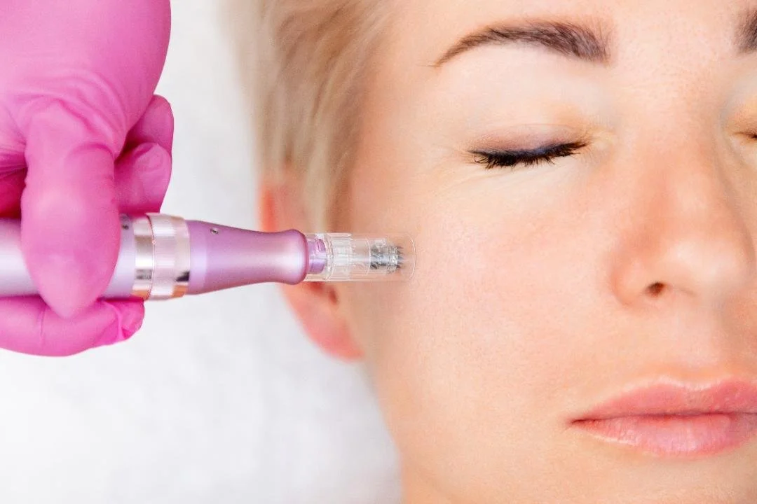 Microneedling: Is It Worth It?