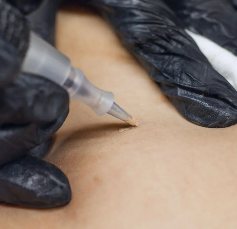 How Long Should You Wait Before Tattooing a Scar?