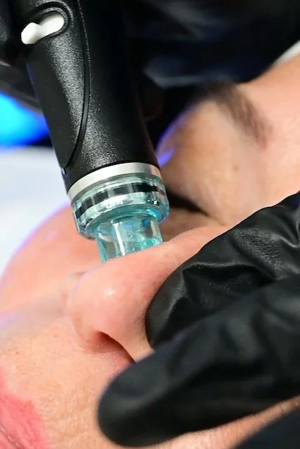 Close-up of a HydraFacial treatment in progress, showing a technician using a blue-tipped device on a client’s cheek to deeply cleanse and hydrate the skin.