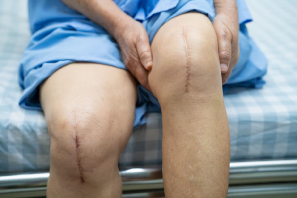 Joint replacement - including shoulder, hip, knee and ankle replacements