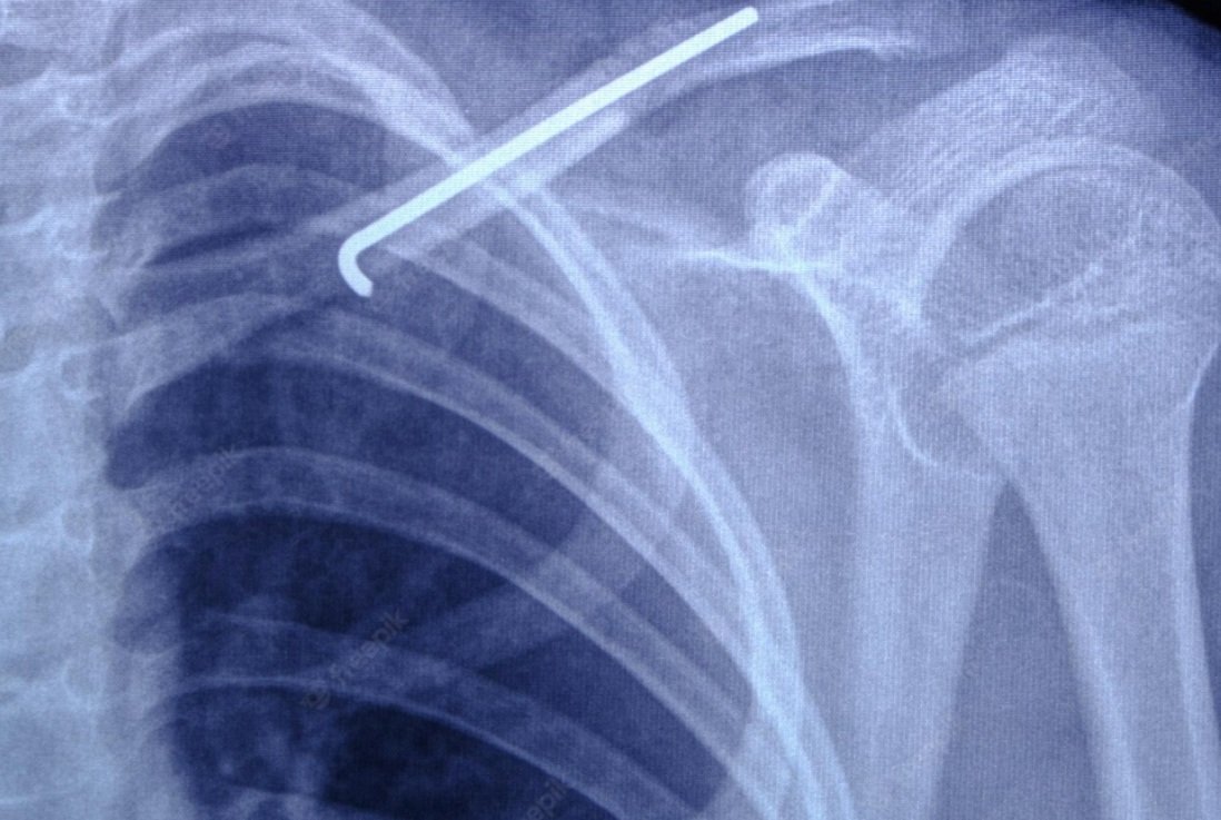 Bone surgery - including fractures, bunionectomy, osteotomies and realignments