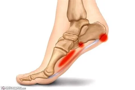 Plantar Fasciitis: What is it? How to relieve it? How to prevent it? 
