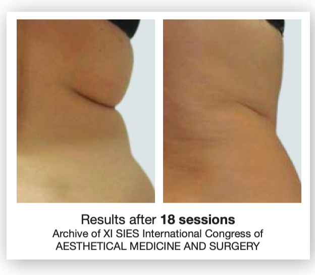Before After 3