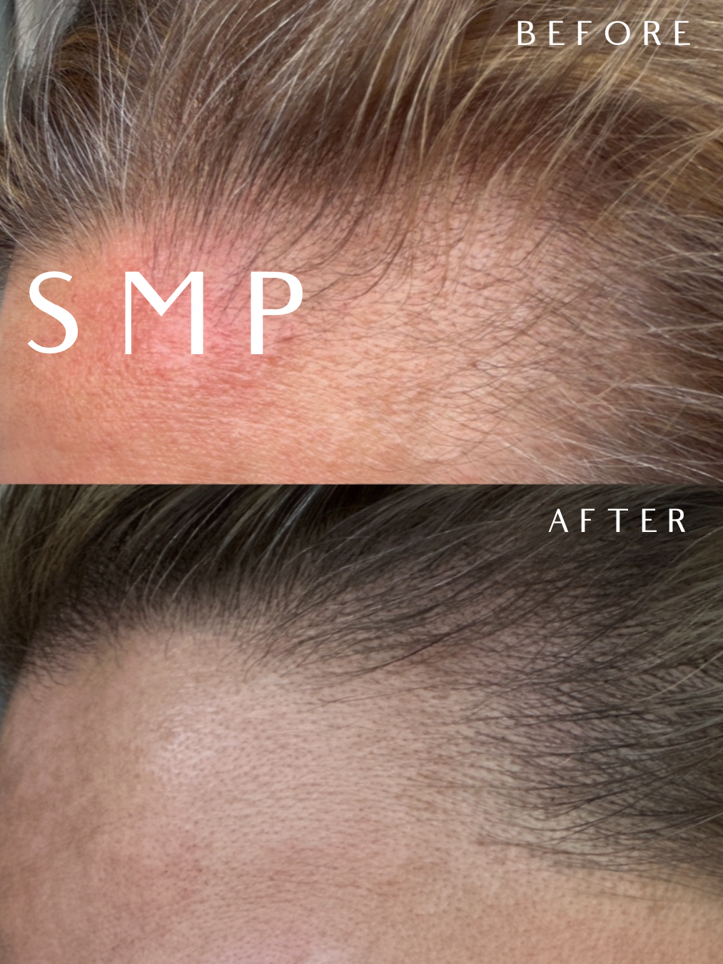 Comparison of scalp before and after scalp micropigmentation, showing reduced redness and hair follicle appearance.
