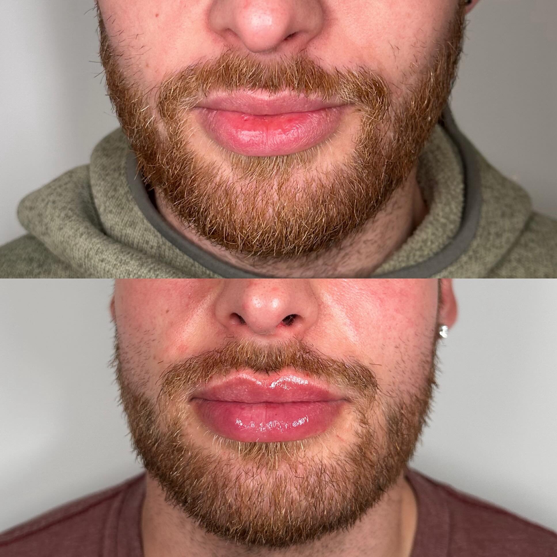 Two Lip Filler treatments over six months, and here we are!!! 🔥🔥🔥 voluminous while still keeping the natural shape, amazing work by the talented @refreshwithdrtaylor 💉

@refreshedmd NW Portland📍
For appointments call/text 503.208.6479 or book on