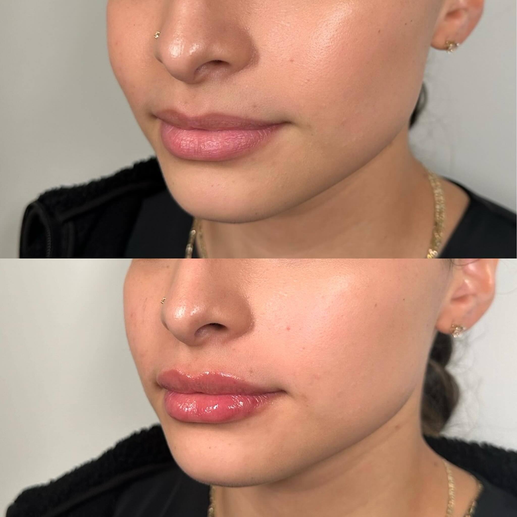 A little goes a long way 👄 this client wanted to give her already plump lips, just a little more hydration 💦
Mini Lip Filler by @refreshedwith.tracy ✨

Call/text 503.208.6479 or BOOK online at refreshedmd.com 🤍🗓️
@refreshedmd NW Portland📍

#refr
