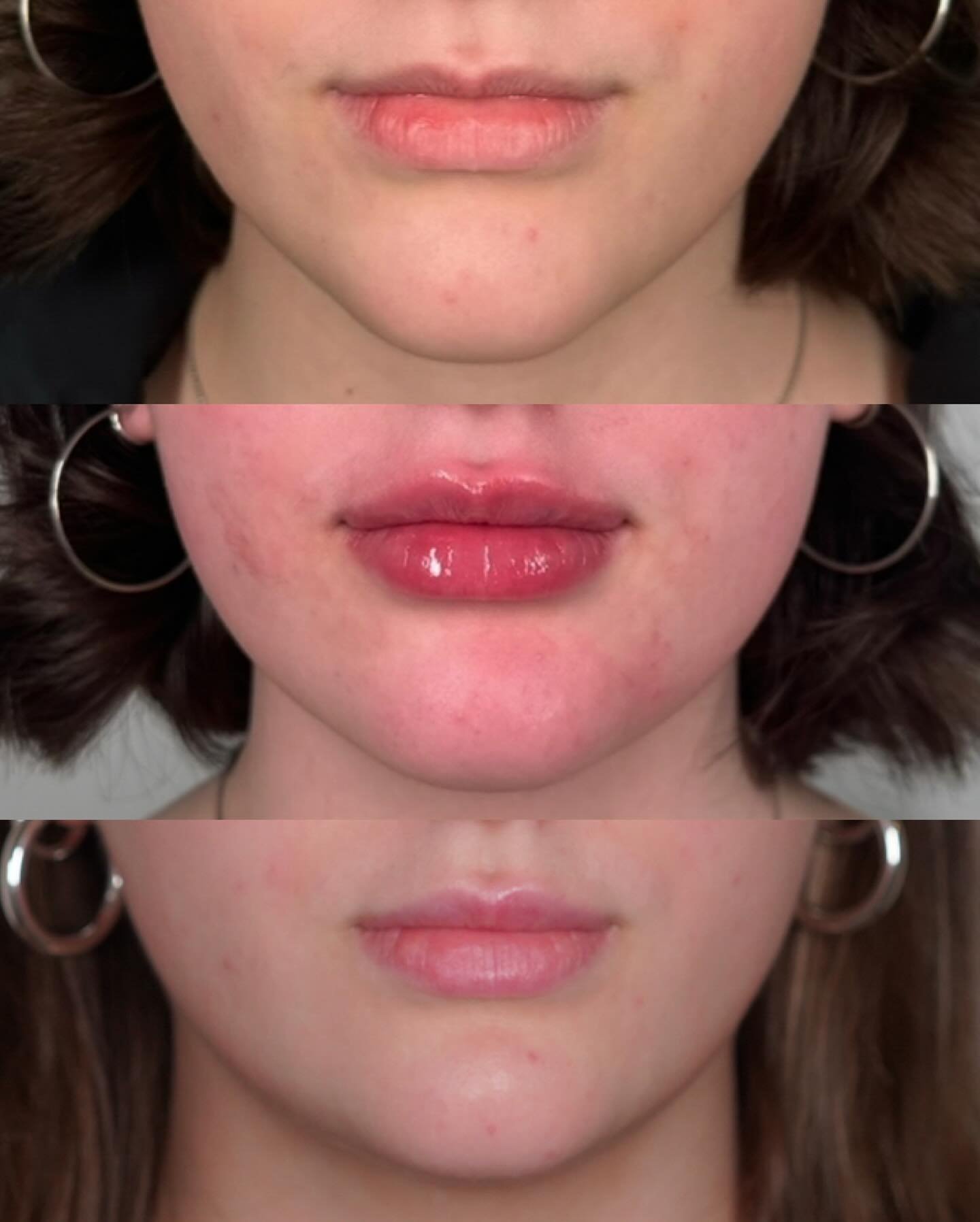 Pre-filler, post-filler, and fully-healed lips!✨👄 by @refreshedwith.tracy 🪄

~

@refreshedmd NW Portland📍
For appointments call/text 503.208.6479 or book online at refreshedmd.com 

#refreshedmd #pdx #pdxnow #lipfiller #pearldistrictpdx #portland 
