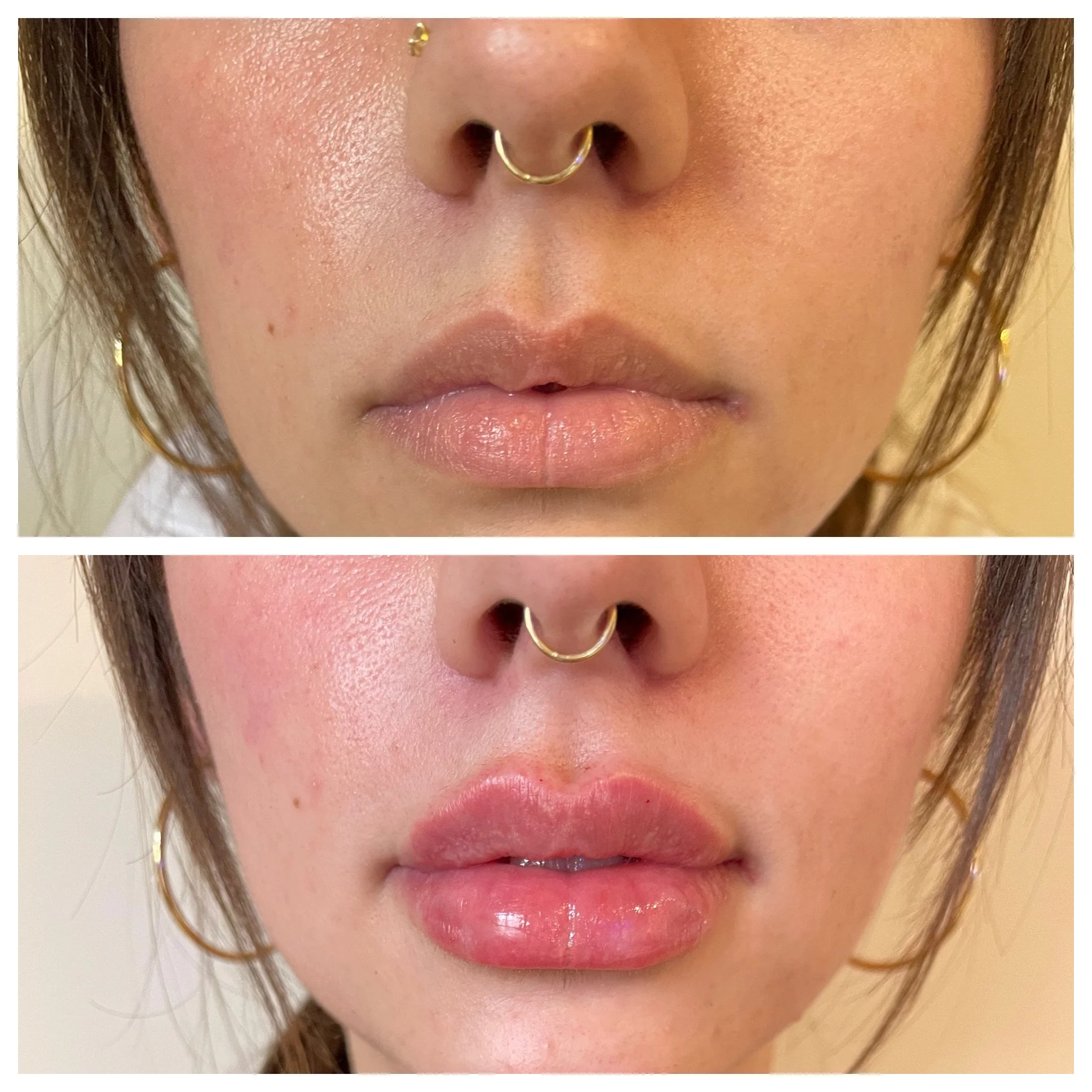 Lip Injections Tox (Botox, wrinkle relaxers) and dermal filler. Visit