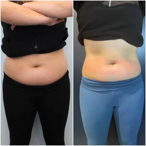 4-CryoSlimming®-treatments.jpg