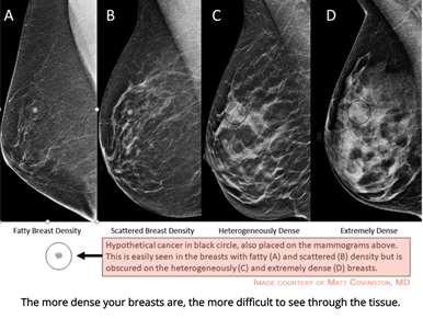 br/>Breast Density: A Starter Guide — Micrima