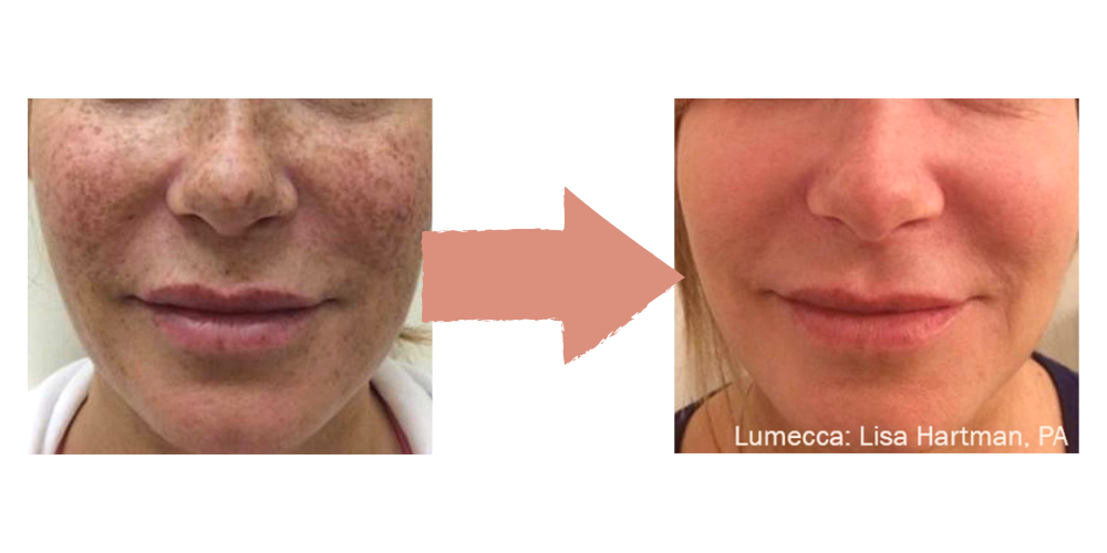 Lumecca IPL Results – Fort Lauderdale Patient