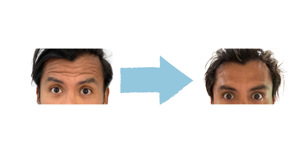 Forehead Results with Botox – Fort Lauderdale Patient