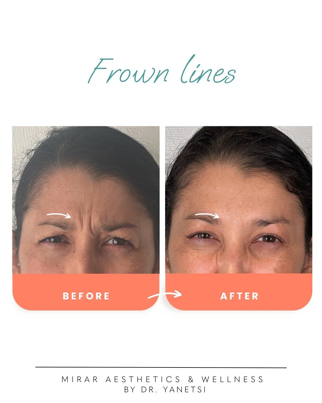 Why Does Sofia Love Her Botox Transformation

👉 Swipe to see her results!
Dr. Yanetsi treated:
✔ Forehead lines
✔ Frown lines
✔ Crow&rsquo;s feet

Gradual, subtle tweaks like our preferred neurotoxin, Xeomin&mdash;create a big impact over time, keep