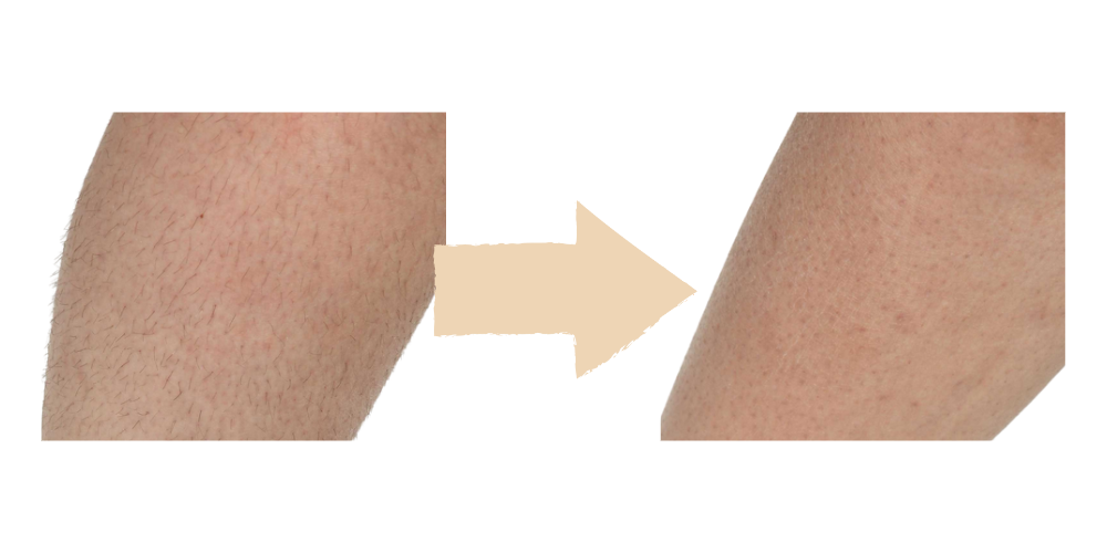 Laser Hair Removal Results – Fort Lauderdale Patient