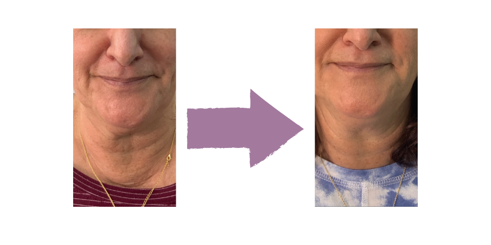 Radiesse Filler Neck Results - Fort Lauderdale Patient