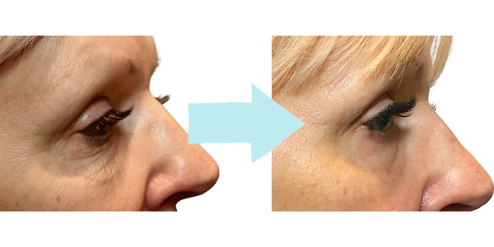 Morpheus8 Eye Results – Fort Lauderdale Patient