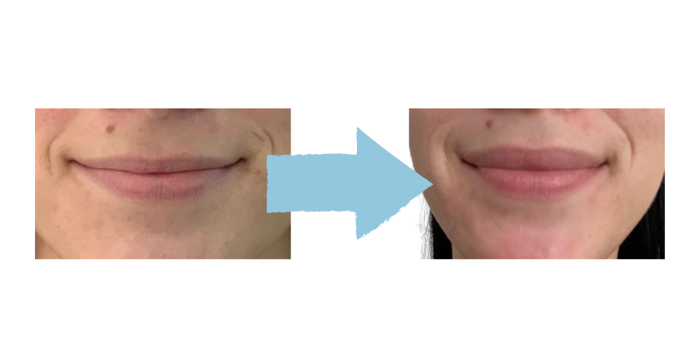 Lip Flip with Botox Results – Fort Lauderdale Patient